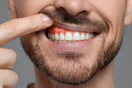 Man showing inflamed gum on grey background, closeup