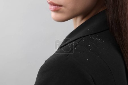 Téléchargez les photos : Femme avec des pellicules sur sa veste sur fond gris clair, gros plan. Espace pour le texte - en image libre de droit