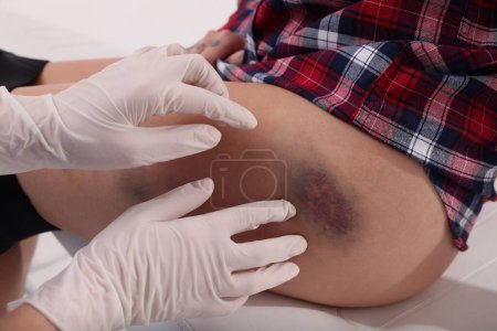 Photo for Doctor examining patient's bruised hip in hospital, closeup - Royalty Free Image