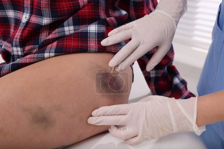 Photo for Doctor examining patient's bruised hip in hospital, closeup - Royalty Free Image