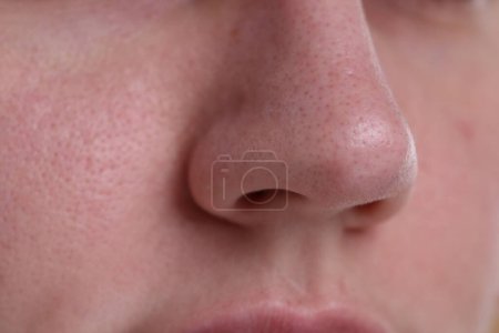 Closeup view of woman with blackheads on her nose