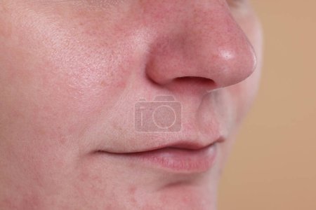 Téléchargez les photos : Vue rapprochée de la femme avec des points noirs sur le nez sur fond beige - en image libre de droit