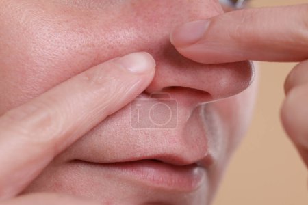 Woman popping pimple on her nose against beige background, closeup