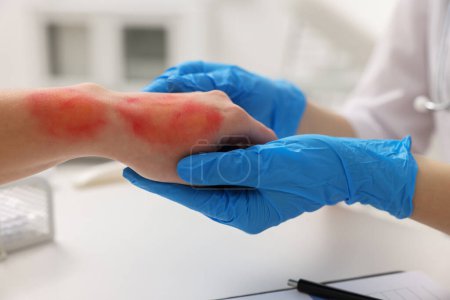 Arzt untersucht verbrannte Hand des Patienten im Haus, Nahaufnahme