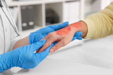 Arzt untersucht verbrannte Hand des Patienten im Haus, Nahaufnahme