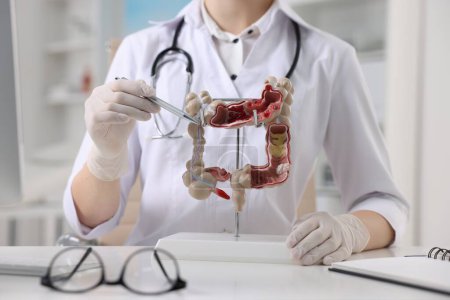 Foto de Gastroenterólogo mostrando el modelo anatómico del intestino grueso en la mesa en la clínica, primer plano - Imagen libre de derechos