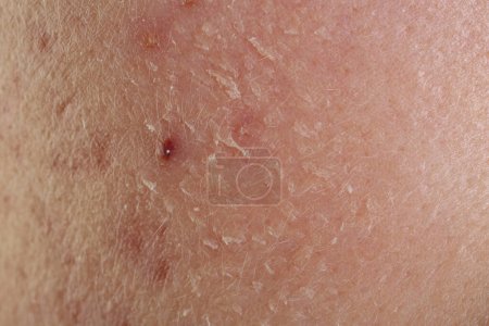 Foto de Textura de la piel con problema de acné como fondo, vista macro - Imagen libre de derechos