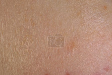 Foto de Textura de piel con marcas de nacimiento como fondo, vista macro - Imagen libre de derechos
