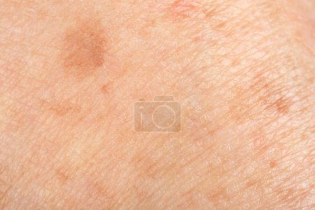 Foto de Textura de la piel con pigmentación como fondo, vista macro - Imagen libre de derechos