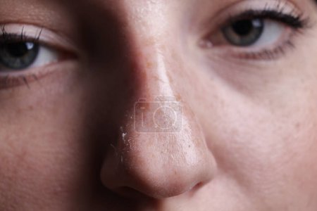 Woman with dry skin on nose, macro view
