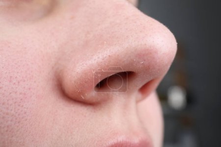 Woman with dry skin on nose, closeup