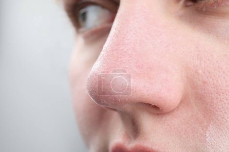 Foto de Mujer con la piel seca en la nariz contra fondo claro, primer plano - Imagen libre de derechos