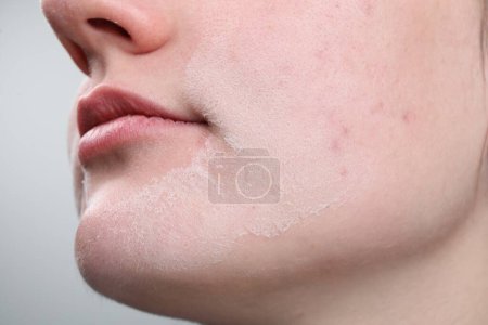 Foto de Mujer con la piel seca en la cara contra el fondo claro, primer plano - Imagen libre de derechos