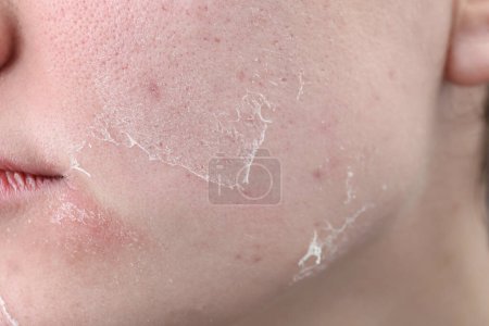 Foto de Mujer con piel seca en la cara, primer plano - Imagen libre de derechos