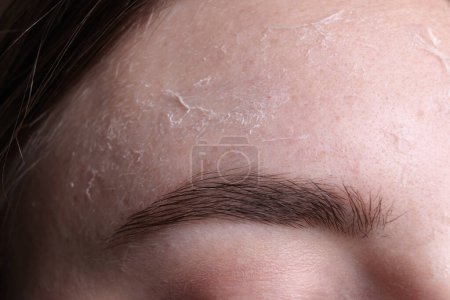 Foto de Mujer con la piel seca en la frente, vista macro - Imagen libre de derechos