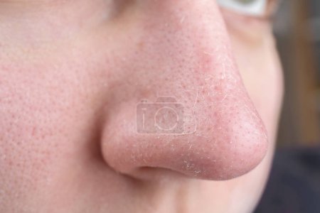 Woman with dry skin on nose, closeup