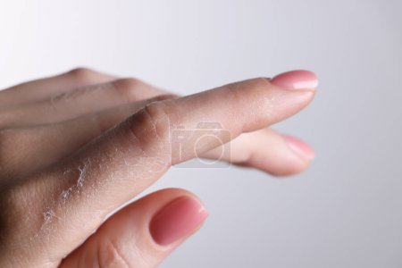 Foto de Mujer con la piel seca en la mano contra el fondo claro, vista macro - Imagen libre de derechos