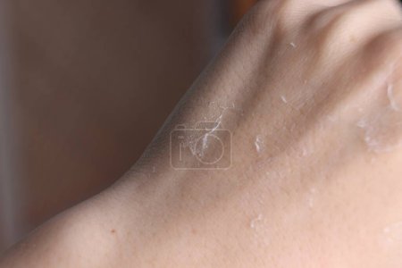 Foto de Mujer con la piel seca en la mano contra fondo borroso, vista macro - Imagen libre de derechos