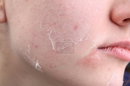Téléchargez les photos : Femme avec peau sèche sur le visage, gros plan - en image libre de droit