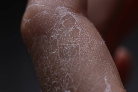 Foto de Mujer con la piel seca en la mano, vista macro - Imagen libre de derechos