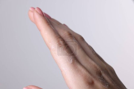 Mujer con la piel seca en la mano contra el fondo claro, vista macro