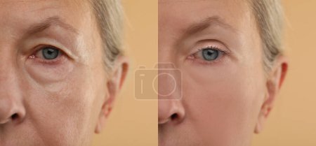 Le vieillissement de la peau change. Femme montrant le visage avant et après le rajeunissement, gros plan. Collage comparant l'état de la peau