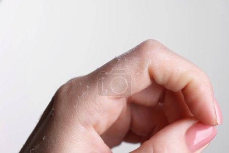 Femme avec peau sèche à portée de main sur fond clair, vue macro