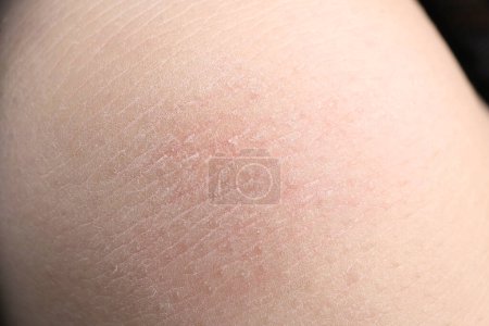 Foto de Vista de cerca de la mujer con la piel seca - Imagen libre de derechos