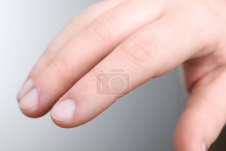 Woman with dry skin on hand against light background, closeup