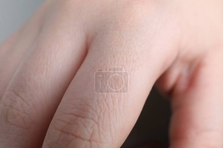 Foto de Mujer con la piel seca en la mano, primer plano - Imagen libre de derechos