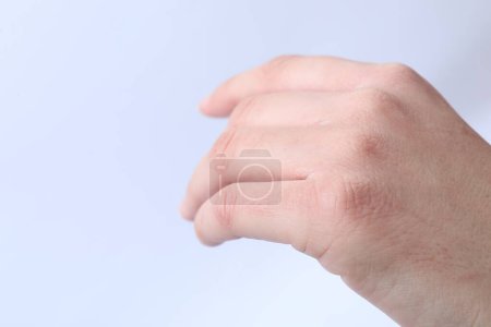 Woman with dry skin on hand against light background, closeup. Space for text