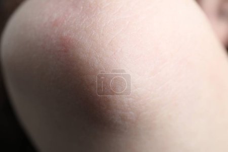 Frau mit trockener Haut am Ellbogen, Nahaufnahme