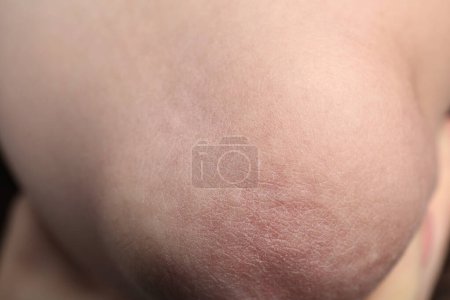 Foto de Mujer con piel seca en el codo, primer plano - Imagen libre de derechos