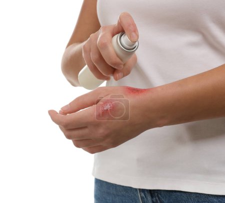 Woman applying panthenol onto burned hand on white background, closeup