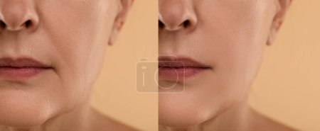Le vieillissement de la peau change. Femme montrant le visage avant et après le rajeunissement, gros plan. Collage comparant l'état de la peau