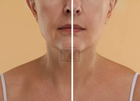 Le vieillissement de la peau change. Femme montrant le cou avant et après le rajeunissement, gros plan. Collage comparant l'état de la peau