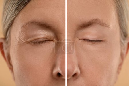 Foto de El envejecimiento de la piel cambia. Mujer mostrando la cara antes y después del rejuvenecimiento, primer plano. Collage comparando condición de la piel - Imagen libre de derechos