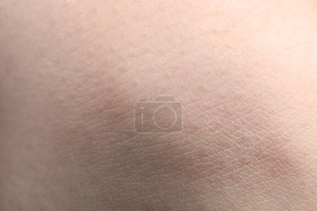 Foto de Vista de cerca de la mujer con la piel seca - Imagen libre de derechos