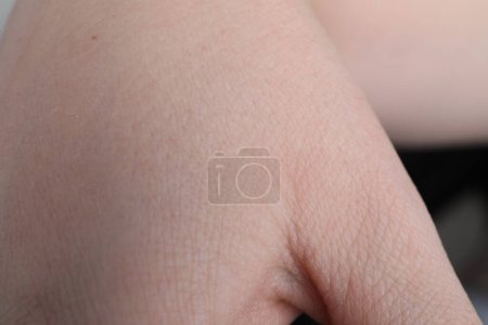 Frau mit trockener Haut an der Hand, Nahaufnahme