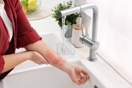 Frau legt Hand mit Verbrennungen unter kaltem fließendem Wasser in geschlossenen Räumen, Nahaufnahme