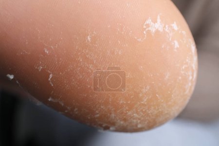 Woman with dry skin on foot, closeup