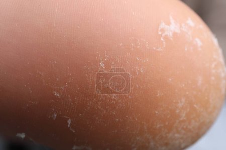 Photo for Woman with dry skin on foot, closeup - Royalty Free Image