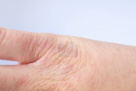 Foto de Mujer con la piel seca en la mano contra el fondo claro, primer plano - Imagen libre de derechos