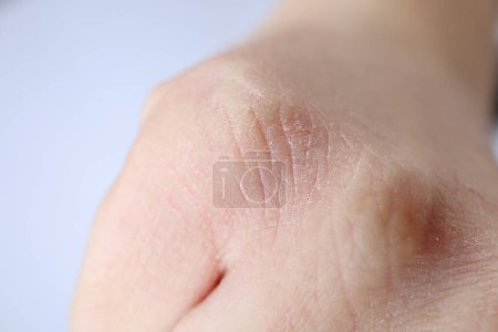 Woman with dry skin on hand against light background, closeup