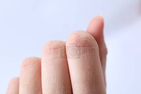 Foto de Mujer con la piel seca en los dedos contra el fondo claro, primer plano - Imagen libre de derechos