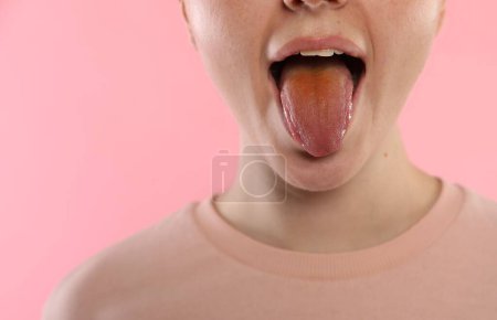Enfermedades gastrointestinales. Mujer mostrando su lengua amarilla sobre fondo rosa, primer plano. Espacio para texto