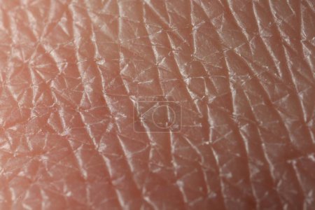 Texture de la peau sèche comme fond, vue macro