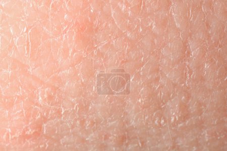 Foto de Textura de piel seca como fondo, vista macro - Imagen libre de derechos