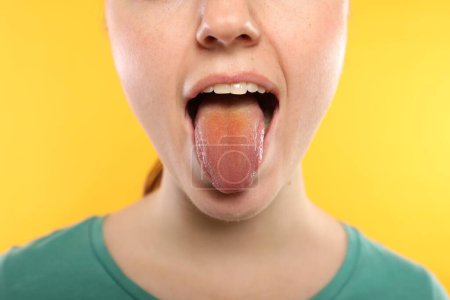 Enfermedades gastrointestinales. Mujer mostrando su lengua amarilla sobre fondo de color, primer plano