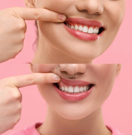 Mujer mostrando goma de mascar antes y después del tratamiento sobre fondo rosa, collage de fotos